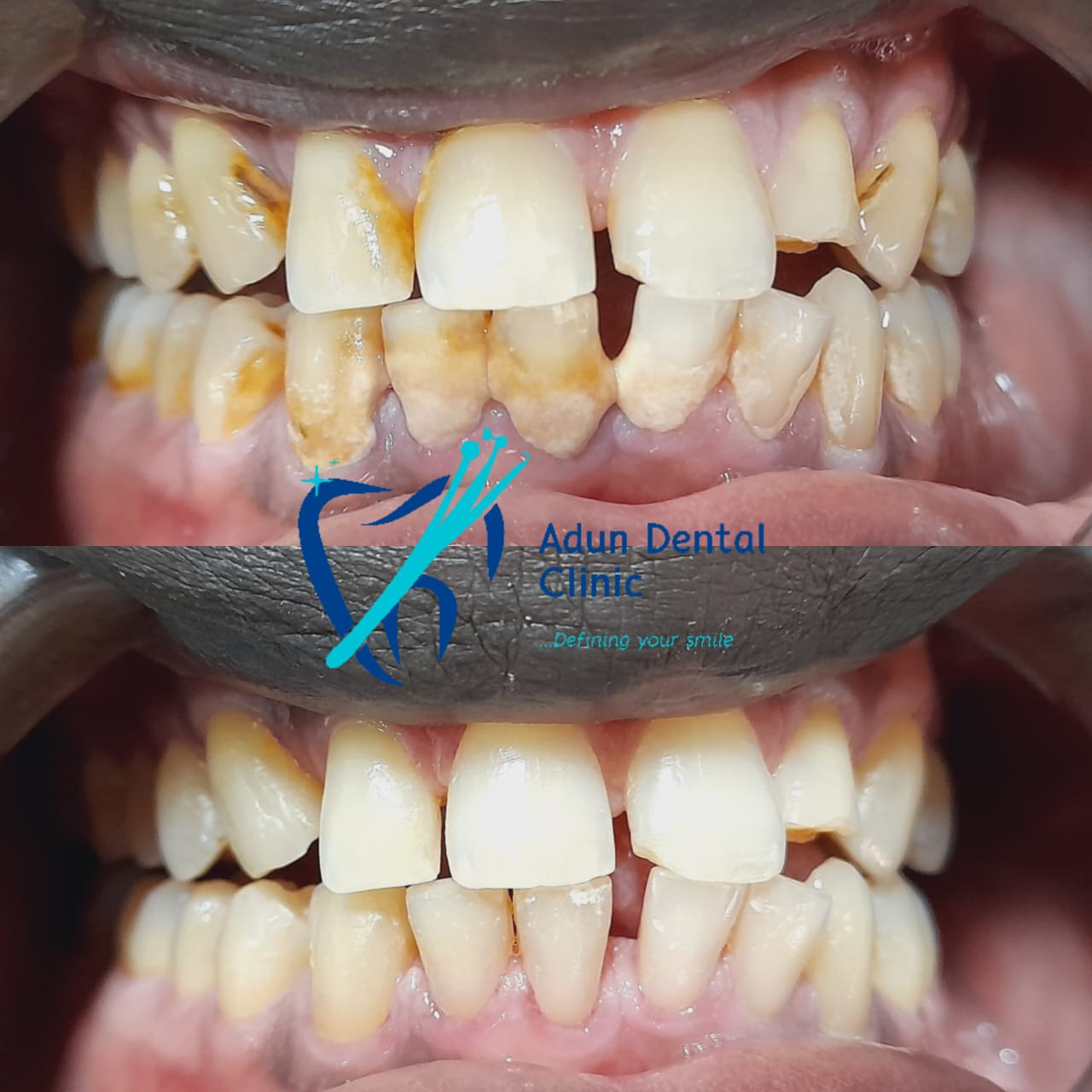 Adun Dental Clinic – Scaling & Polishing