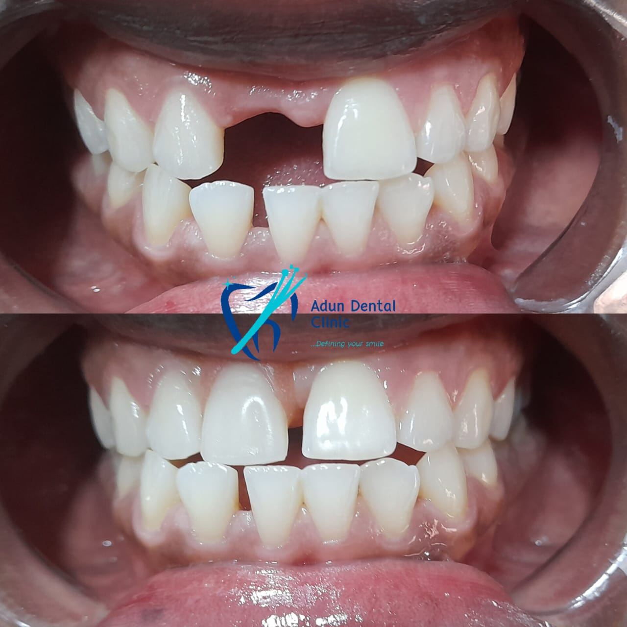 Adun Dental Clinic – Composite Buildup