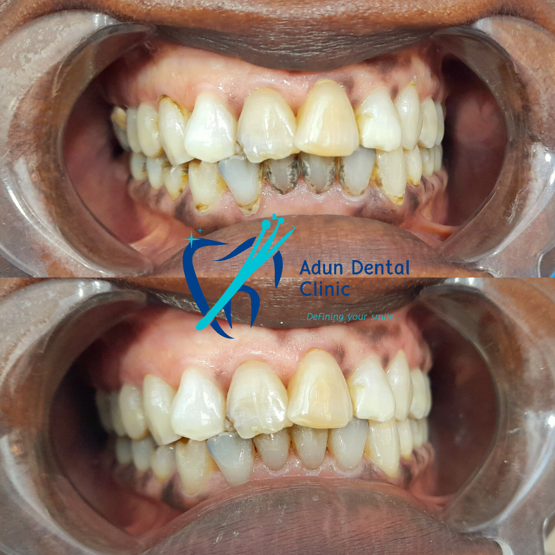 Adun Dental Clinic – Scaling & Polishing