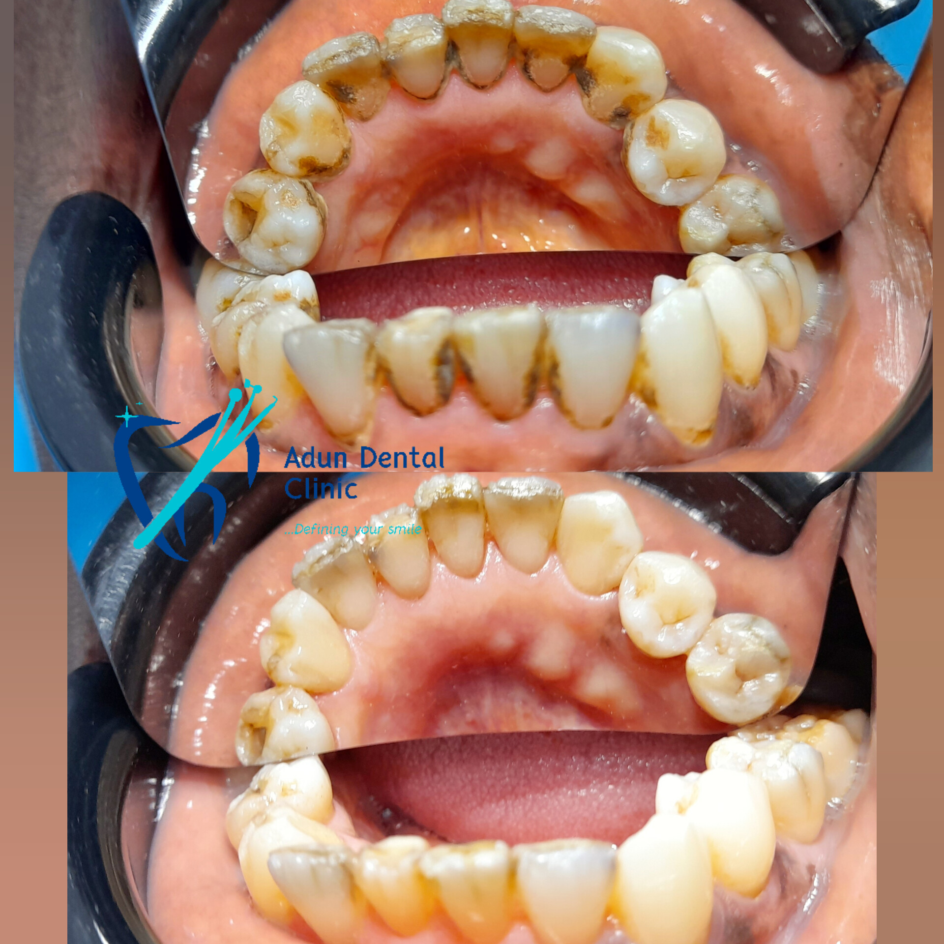 Adun Dental Clinic – Scaling & Polishing