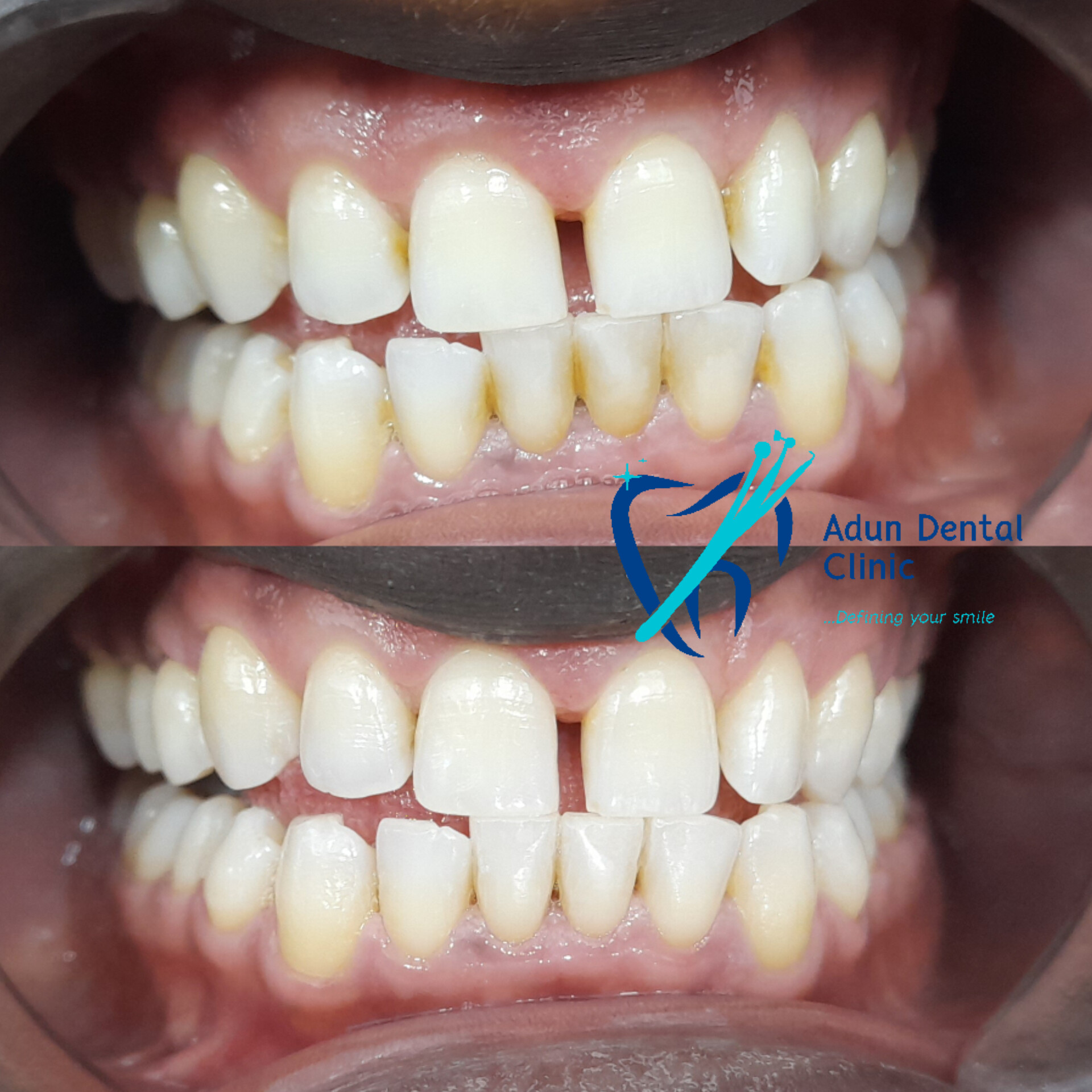 Adun Dental Clinic – Scaling & Polishing