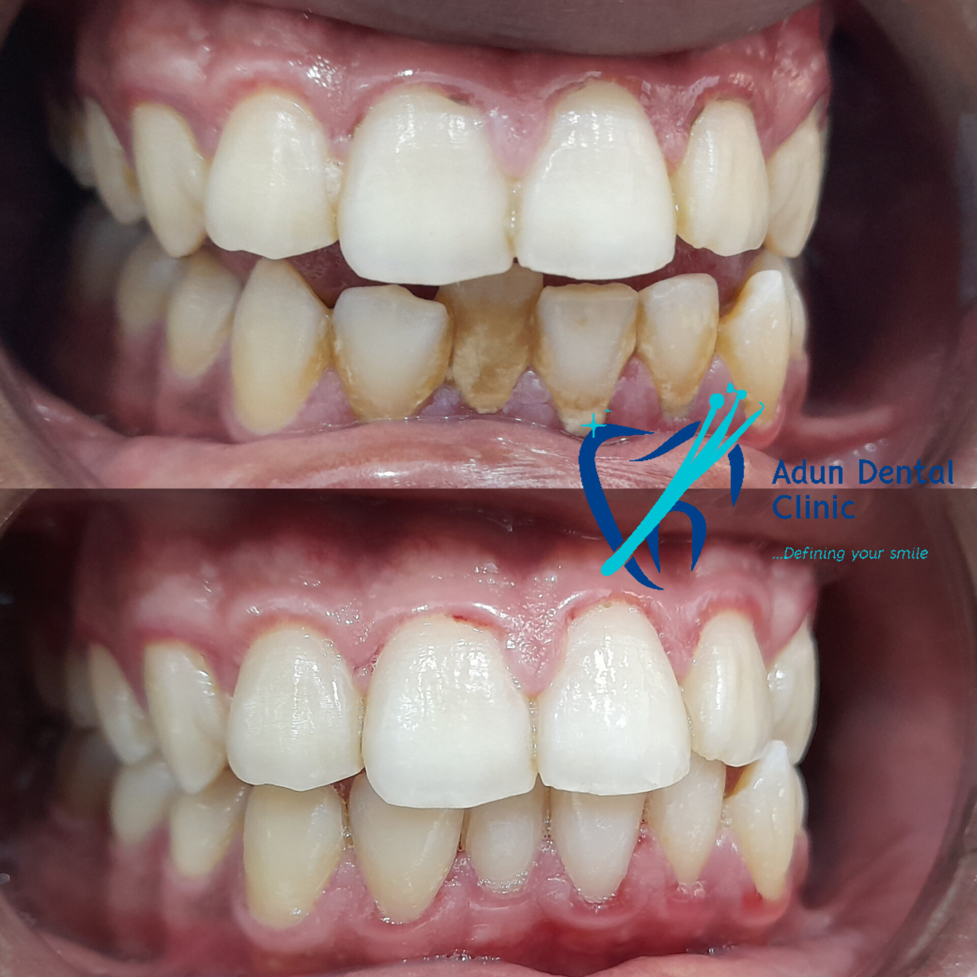 Adun Dental Clinic – Scaling & Polishing