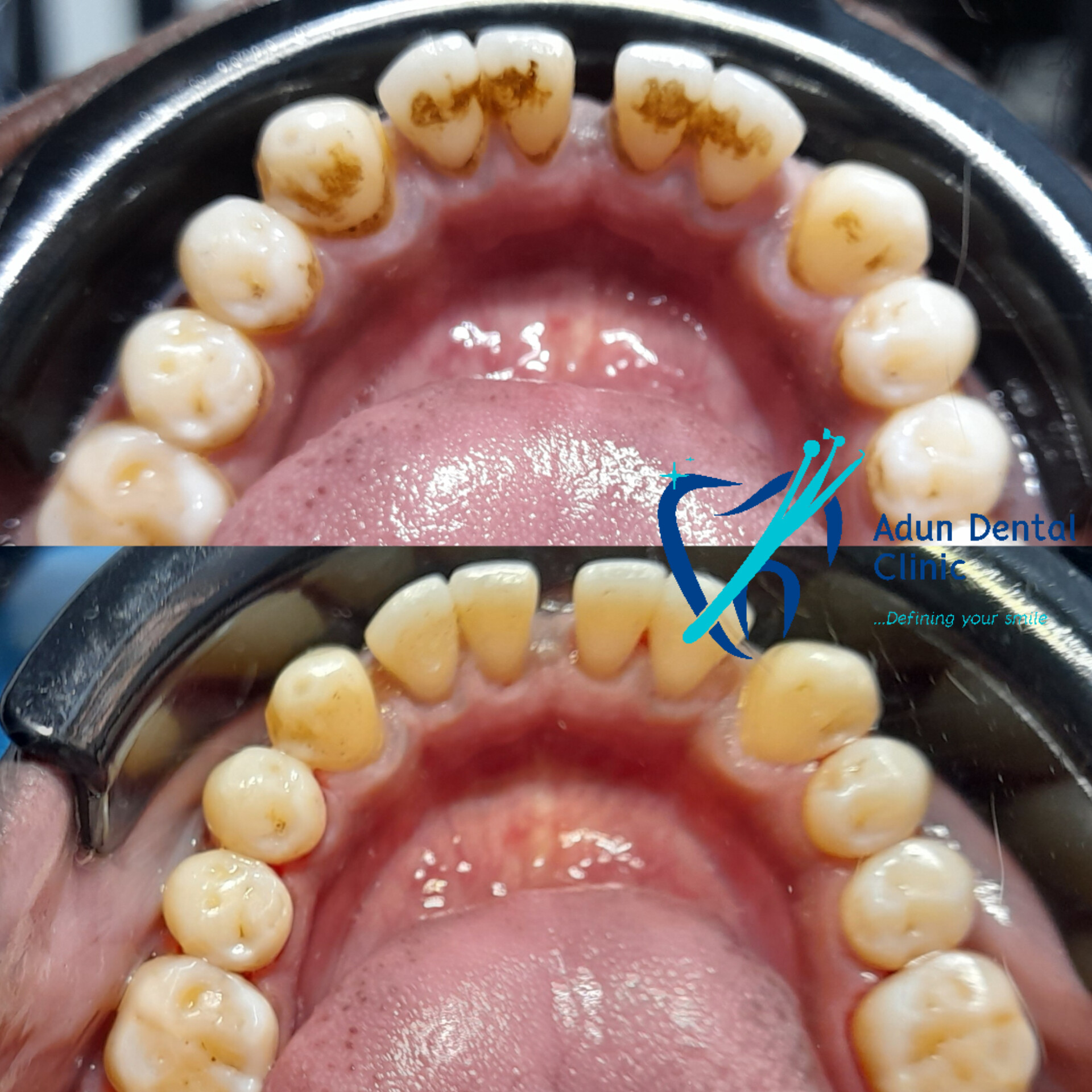 Adun Dental Clinic – Scaling & Polishing