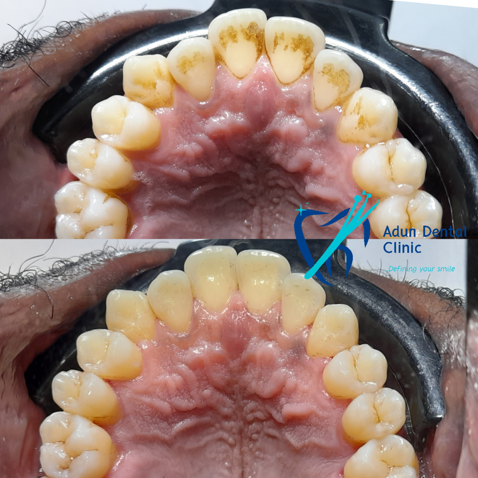 Adun Dental Clinic – Scaling & Polishing