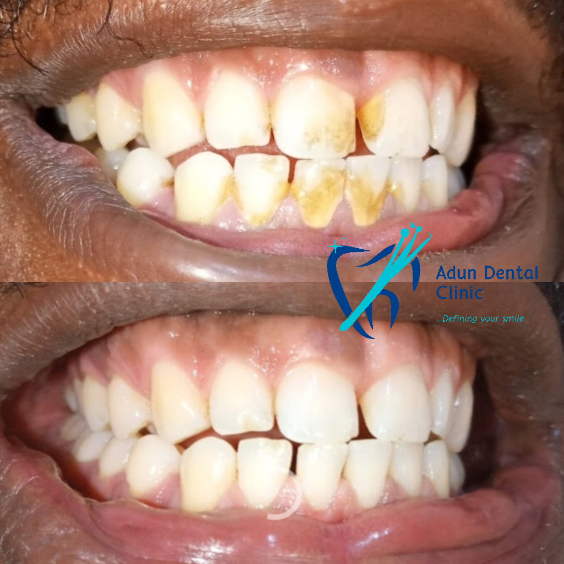 Adun Dental Clinic – Scaling & Polishing