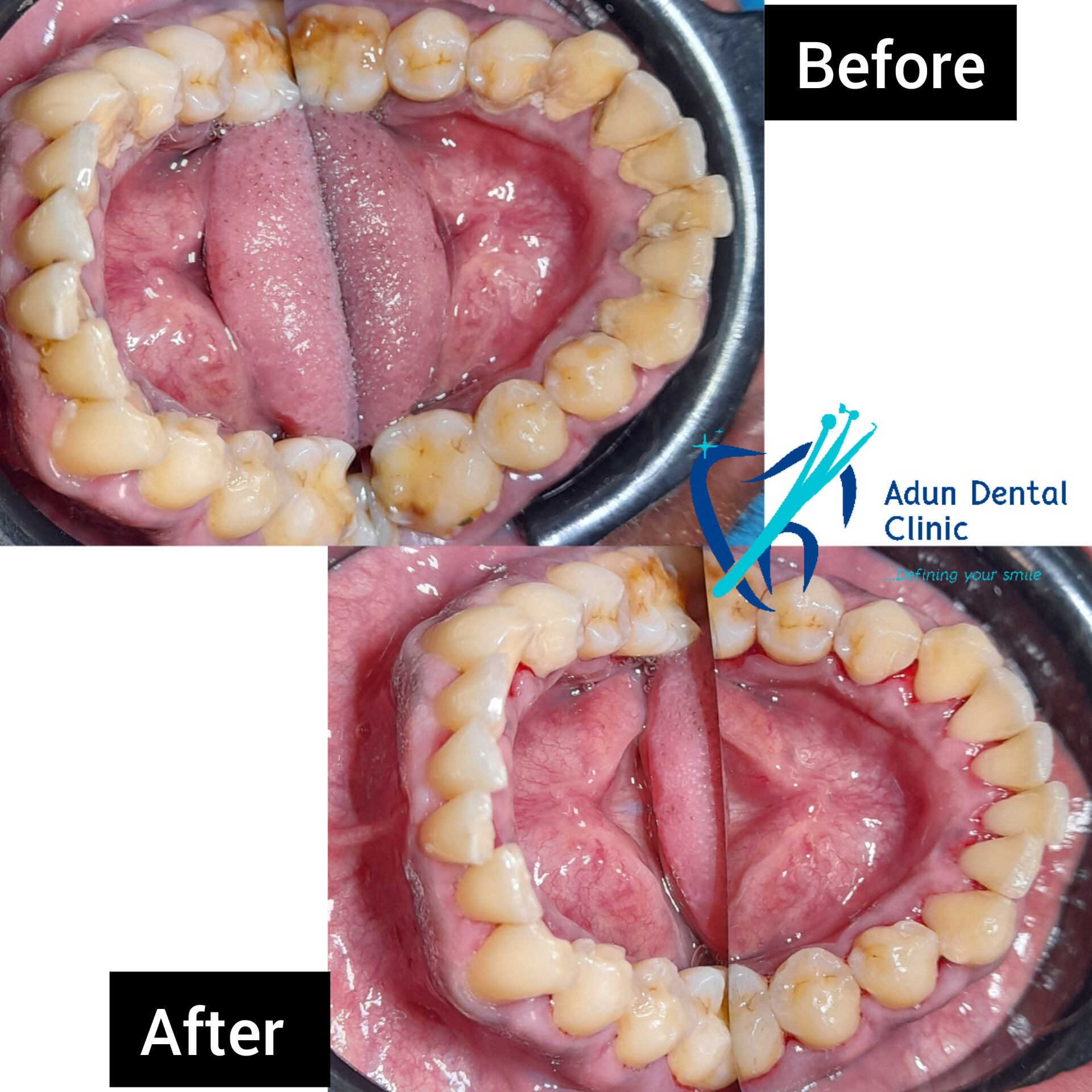 Adun Dental Clinic – Scaling & Polishing