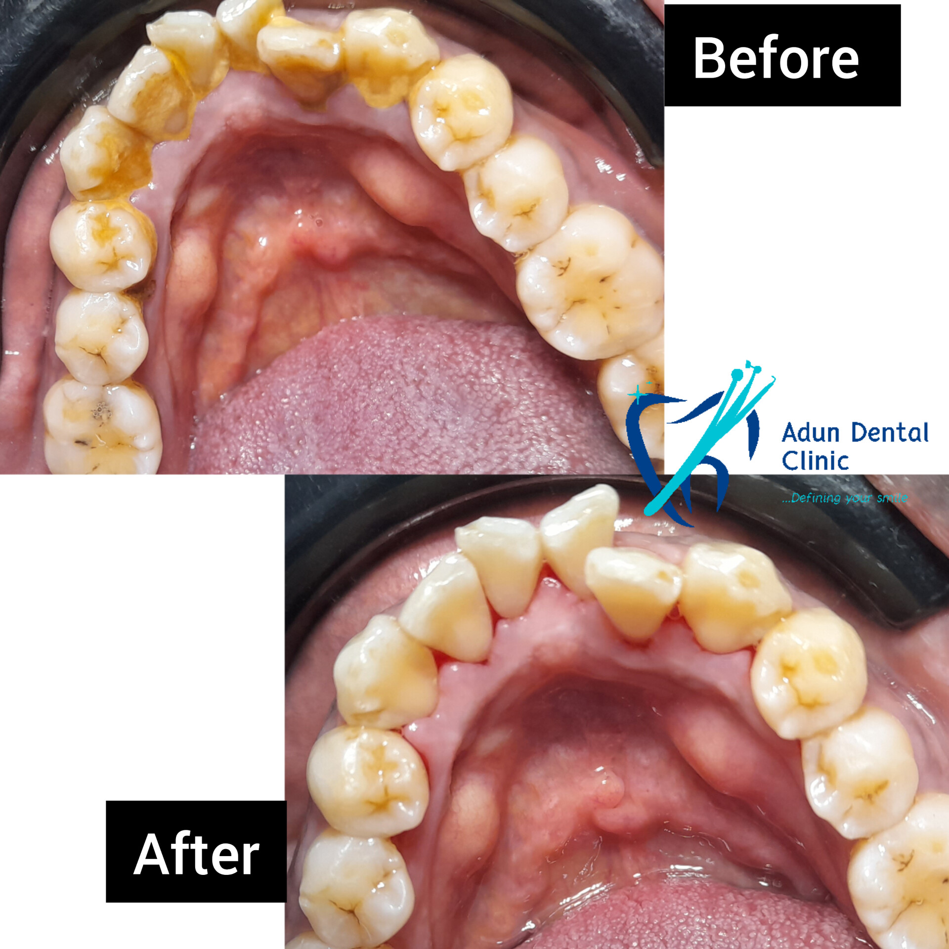 Adun Dental Clinic – Scaling & Polishing