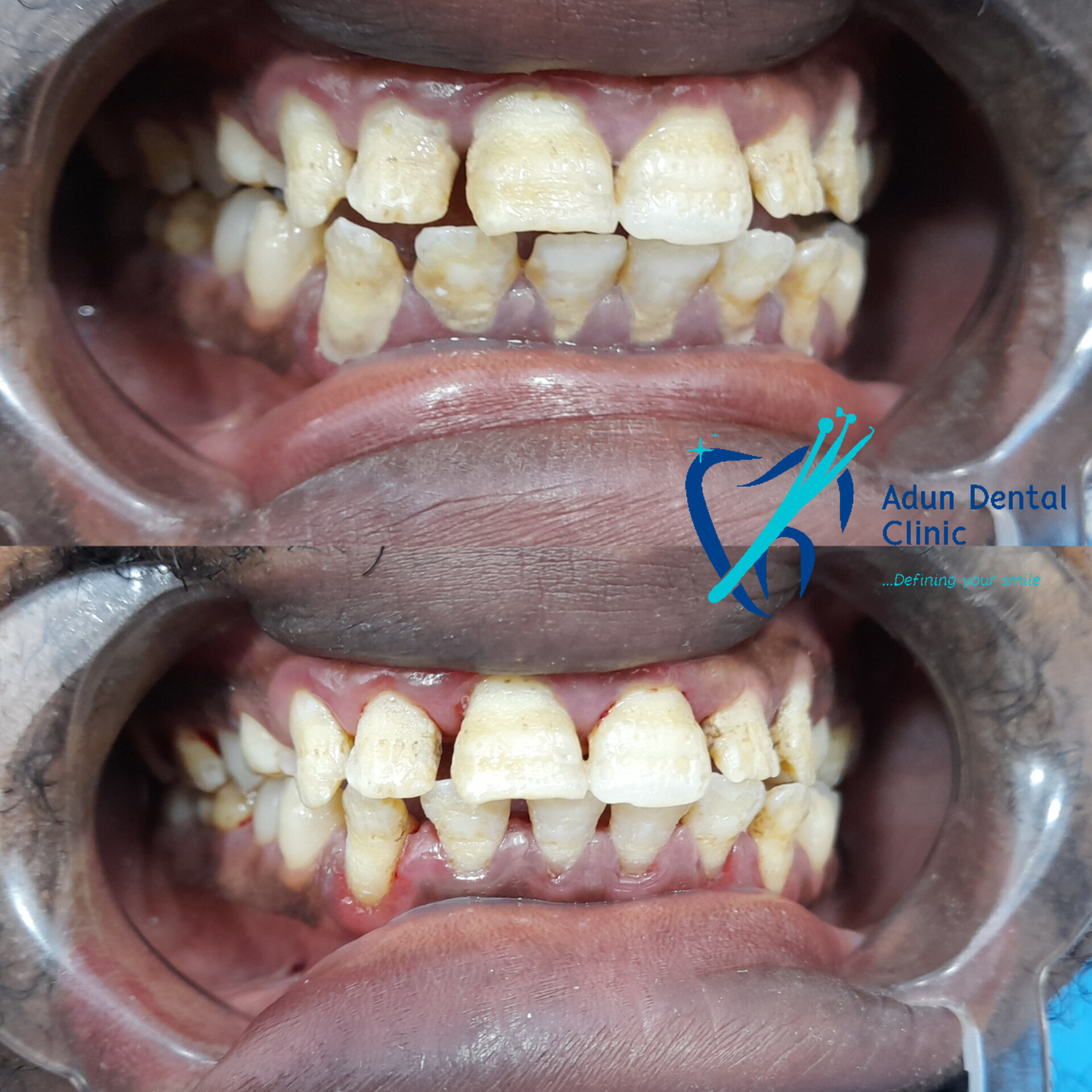 Adun Dental Clinic – Scaling & Polishing