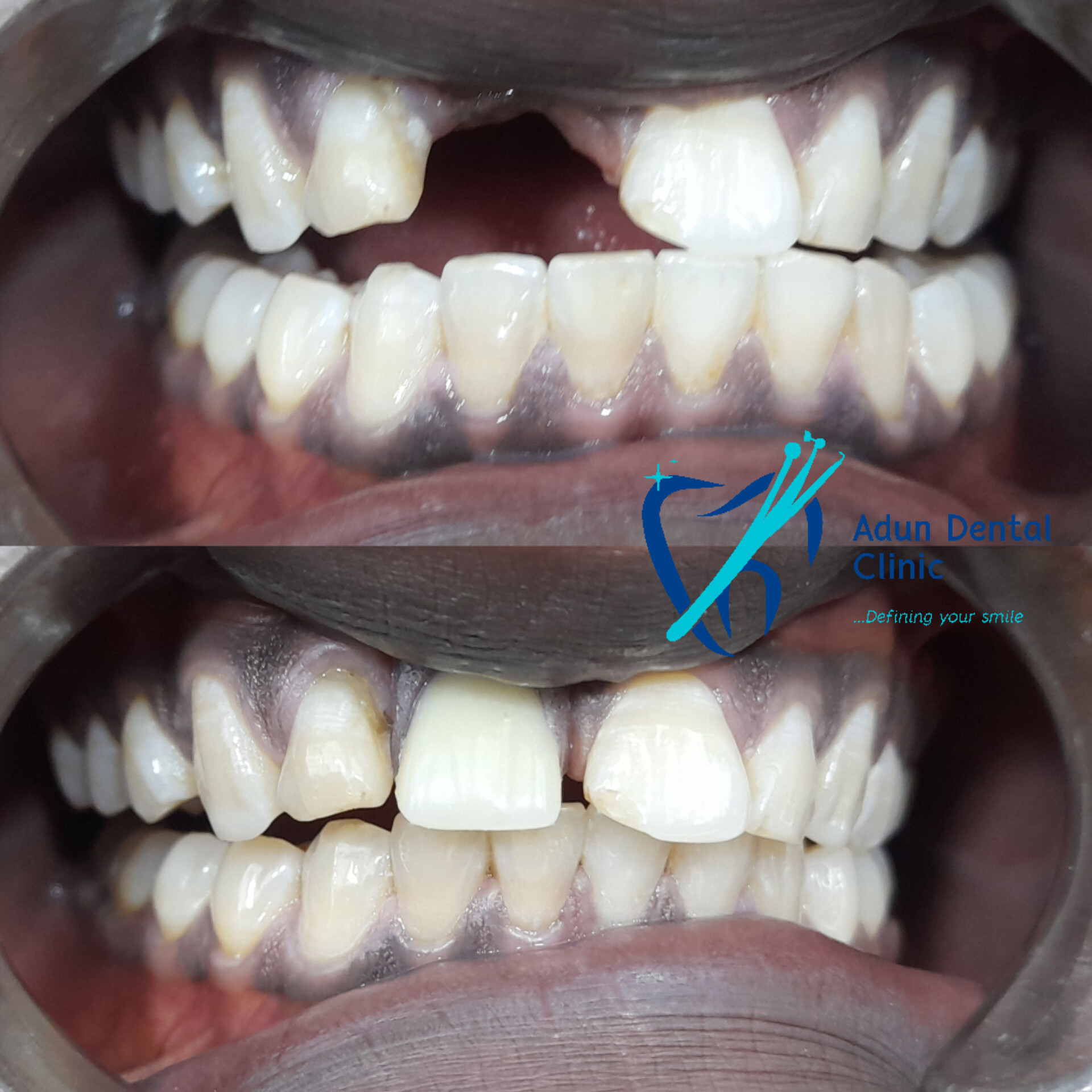 Adun Dental Clinic – Composite Buildup