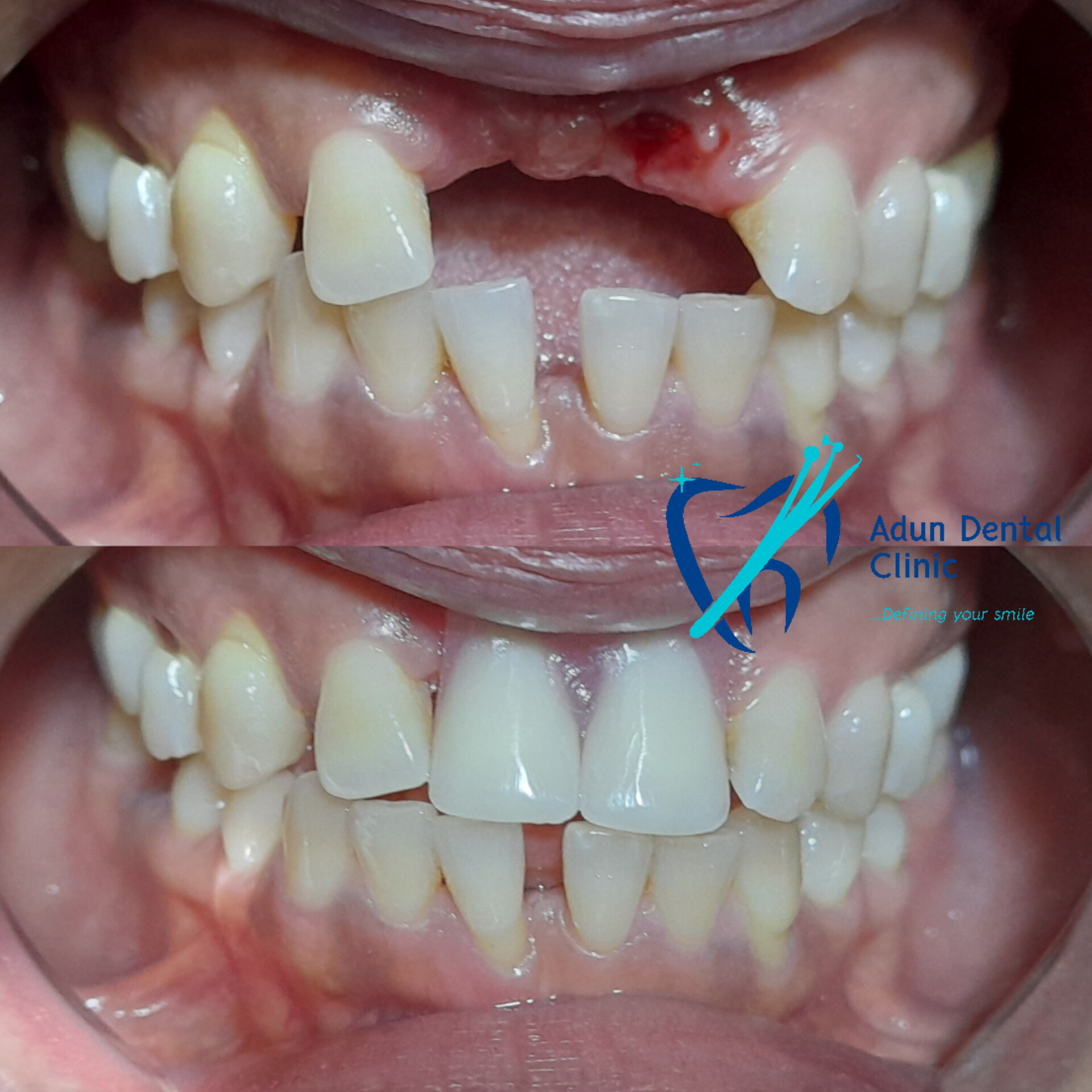 Adun Dental Clinic – Composite Buildup