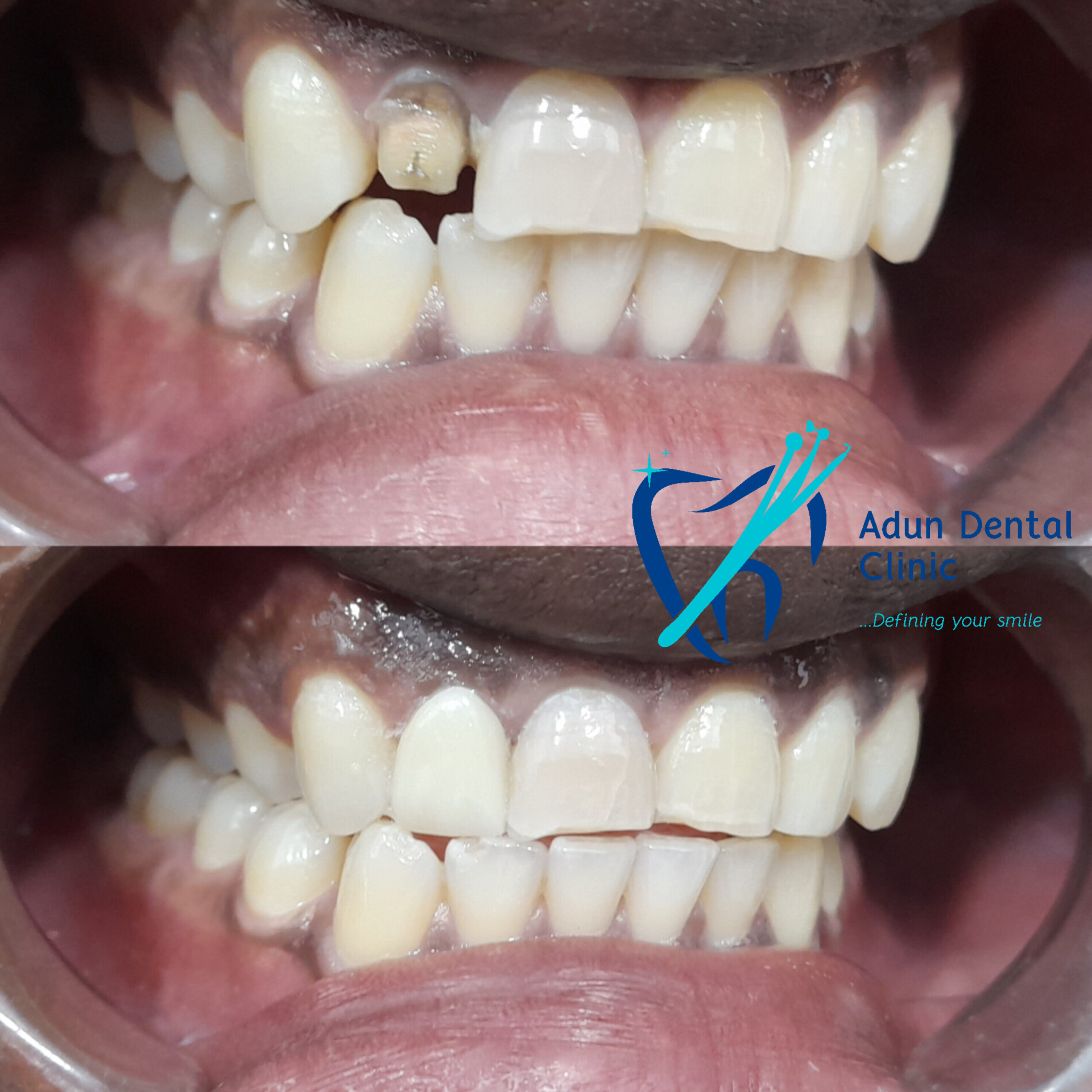 Adun Dental Clinic – Dental Crown