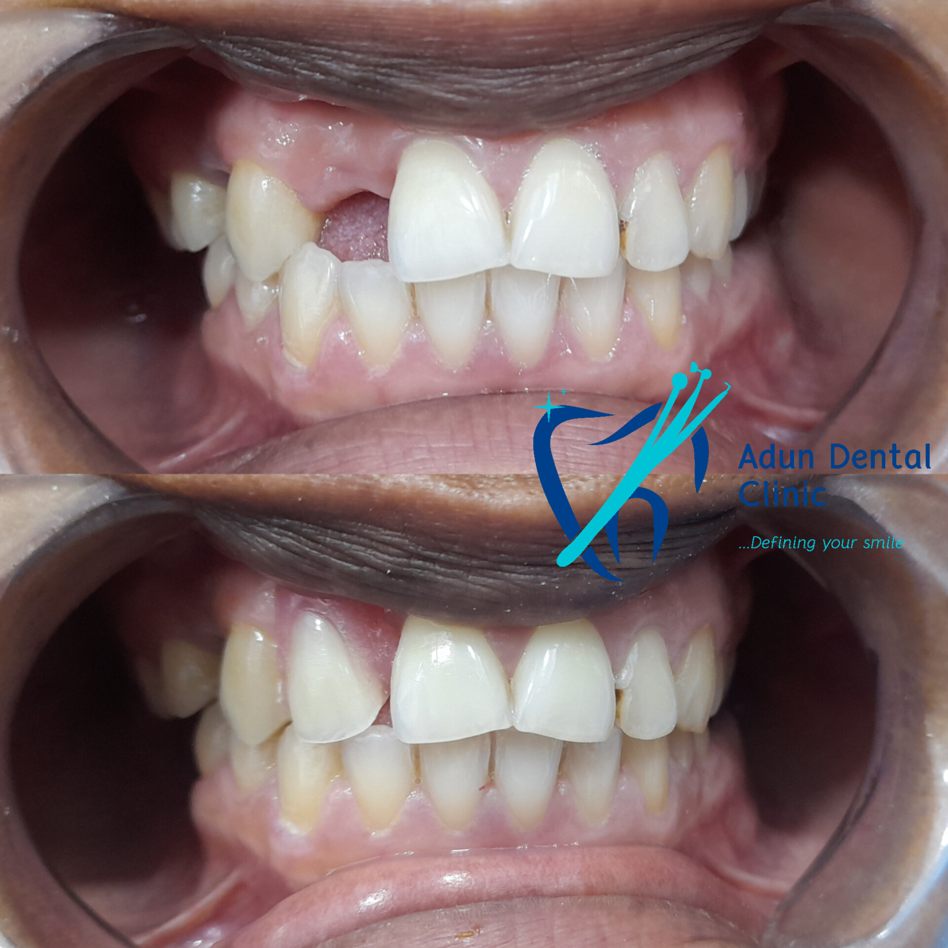 Adun Dental Clinic – Composite Buildup