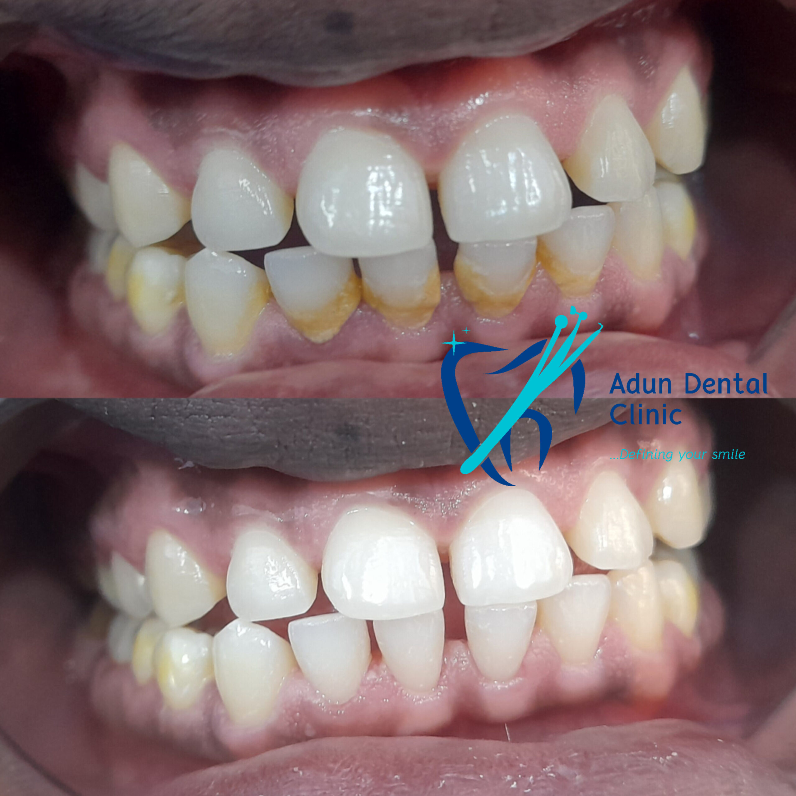 Adun Dental Clinic – Scaling & Polishing