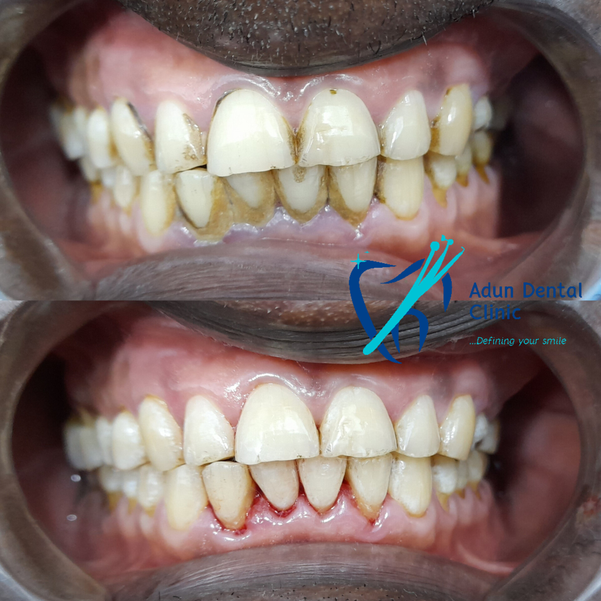 Adun Dental Clinic – Scaling & Polishing