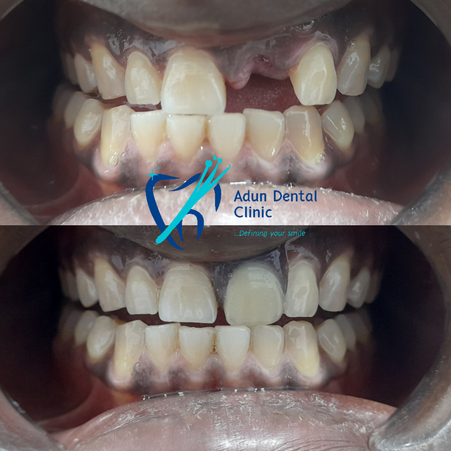 Adun Dental Clinic – Composite Buildup