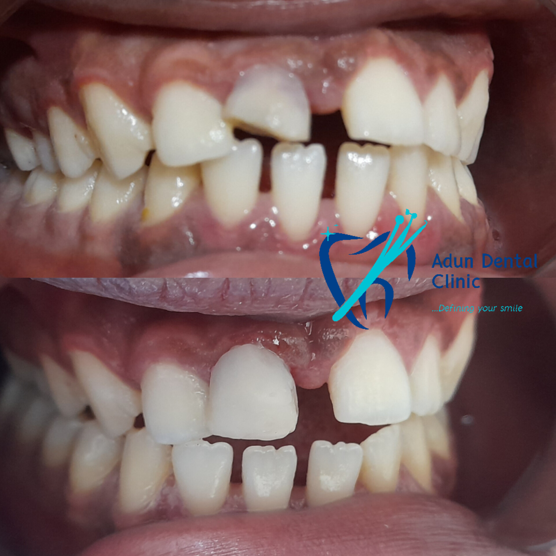 Adun Dental Clinic – Dental Crown