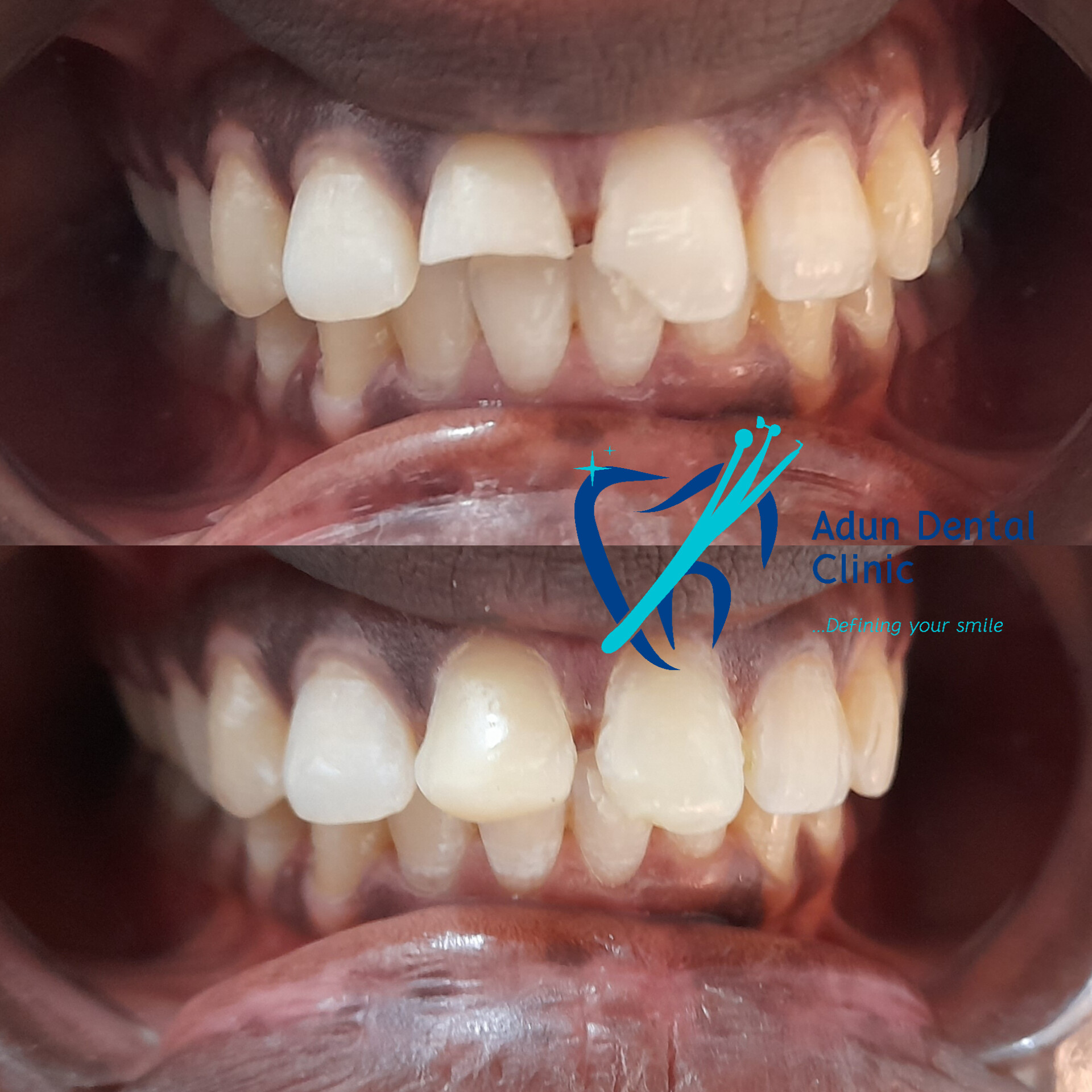 Adun Dental Clinic – Dental Crown