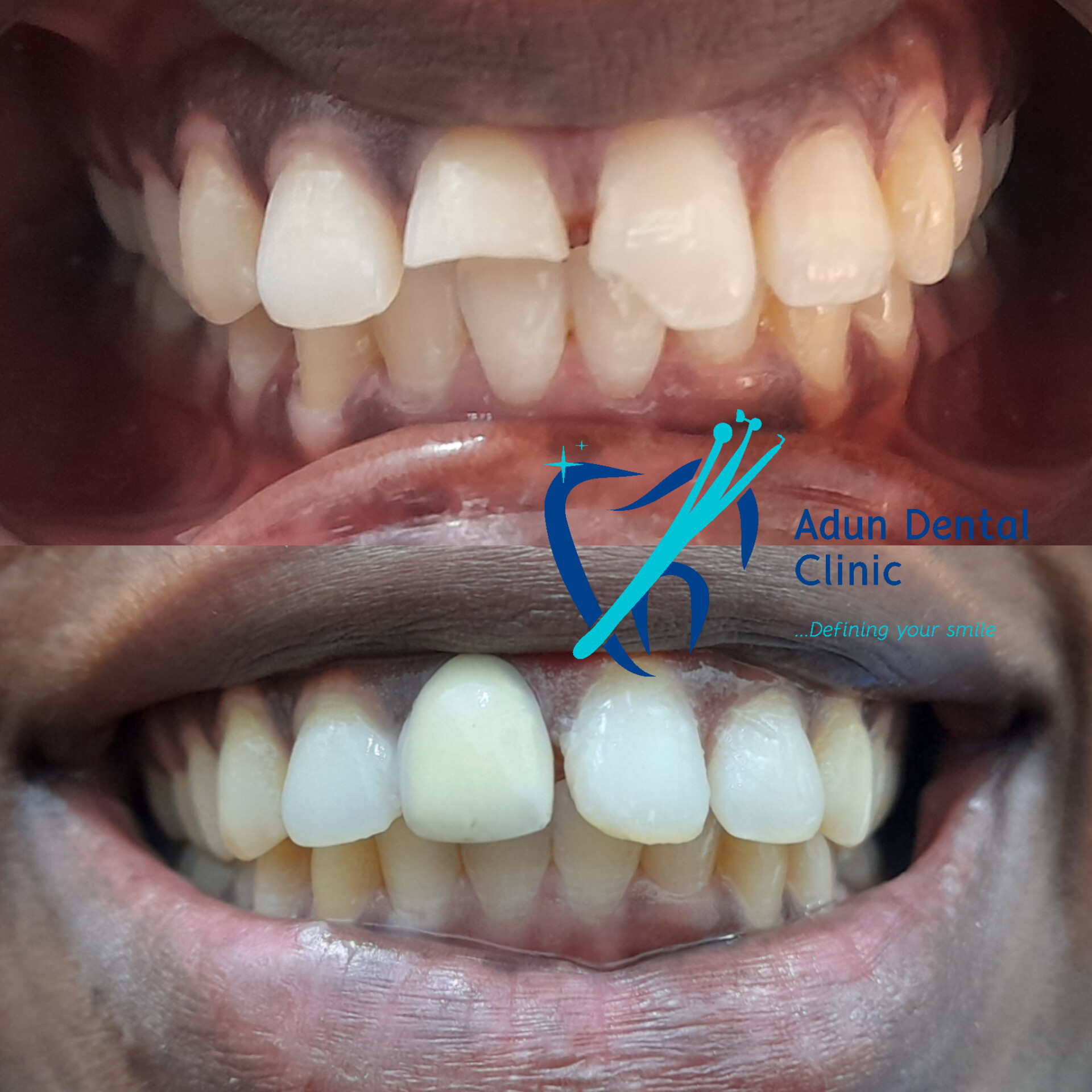 Adun Dental Clinic – Dental Crown